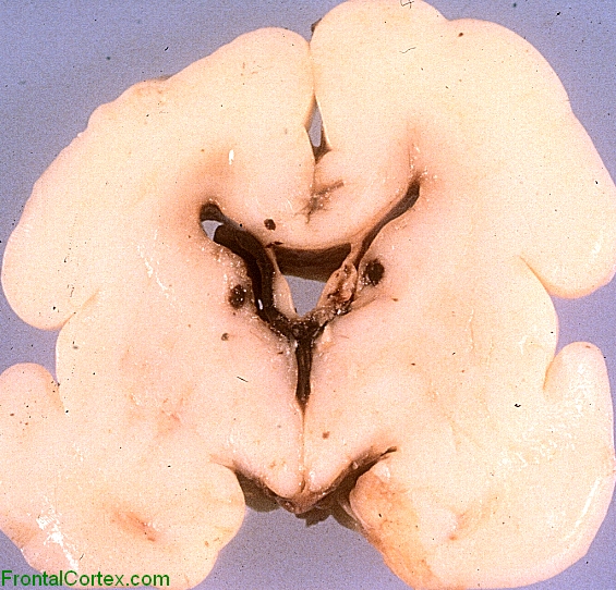 Germinal matrix hemorrhage, with ventricular extension on the left, coronal section of brain.